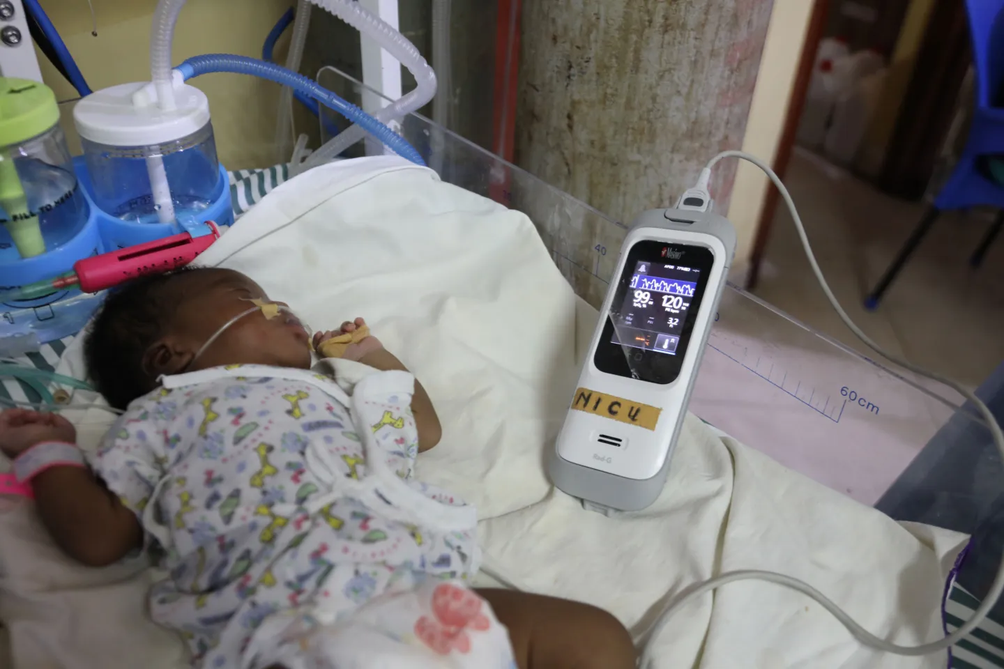 young baby connected to a cpap machine